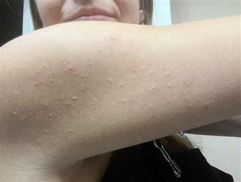White Bumps On Arms