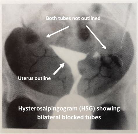 Hysterosalpingogram (HSG) – Women's Health by Dr Lee Say Fatt