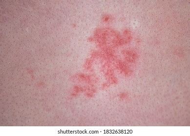 Aids Pictures Of Sores