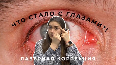 ЛАЗЕРНАЯ КОРРЕКЦИЯ ЗРЕНИЯ || ВСЯ ПРАВДА - YouTube