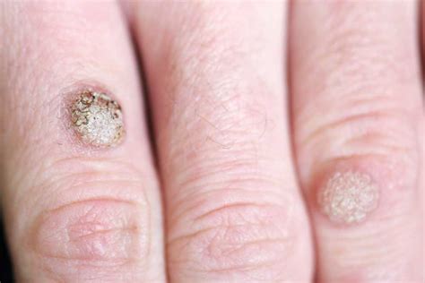 ways  rid  warts wart removal az healthy