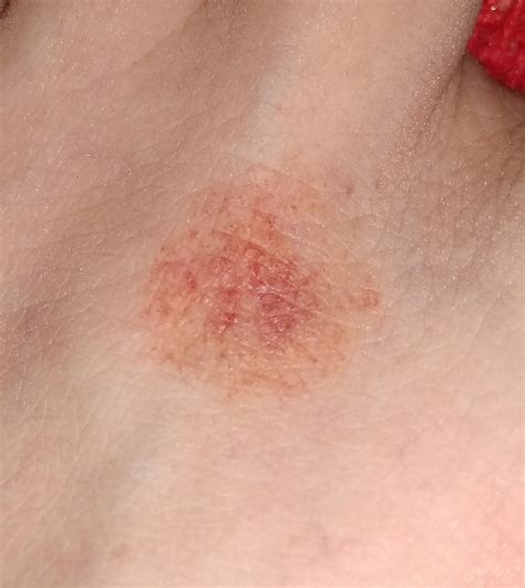 Непонятные красные пятна на стопе Красные пятна, стопа | MedAboutMe