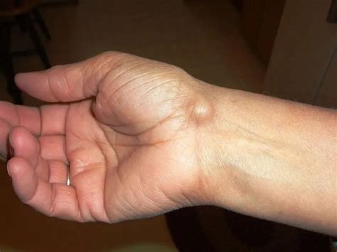 understanding hand lumps whats normal  whats