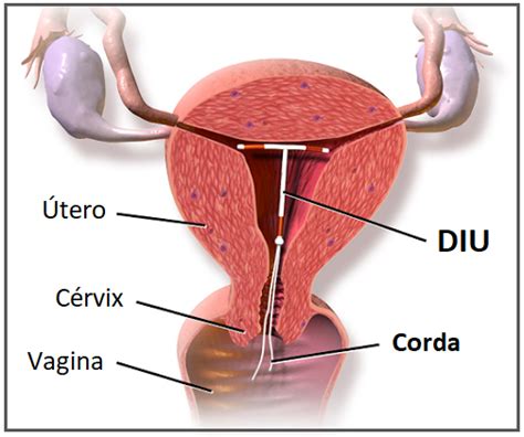 Como É Retirado O Diu - DIU é seguro e efetivo como contraceptivo? - Saber Atualizado