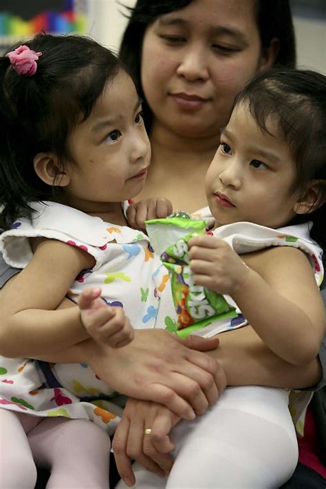 Conjoined twins separated in 10-hour operation