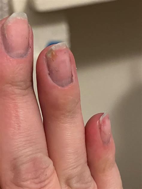 What is this bruise coloration on nail bed? : r/Nails