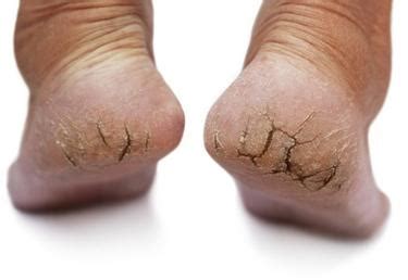 DRY CRACKED HEELS | Foot Medical Centre | Newmarket Foot Specialist ...
