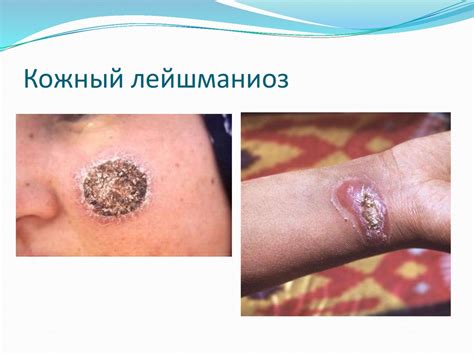 Лейшманиозы - презентация онлайн