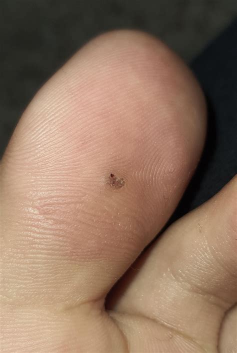 Plantar wart or corn? : r/Warts