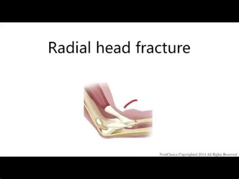 Radial head fracture - YouTube