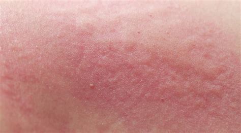 detail jenis gatal  kulit  gambarnya koleksi nomer