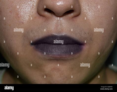 Cyanosis Lips