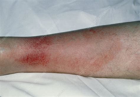 Cellulitis on the leg - Stock Image - M130/0322 - Science Photo Library