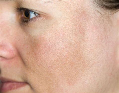 Melasma - Symptoms, Causes And Other Associated Risk Factors