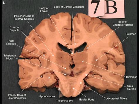 coronal section  brain drawing
