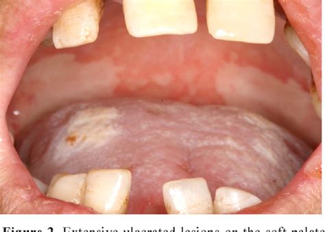 Acute cytomegalovirus (CMV) infection as related to Cough - Pictures