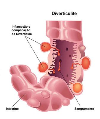 O Que É Diverticulite Aguda