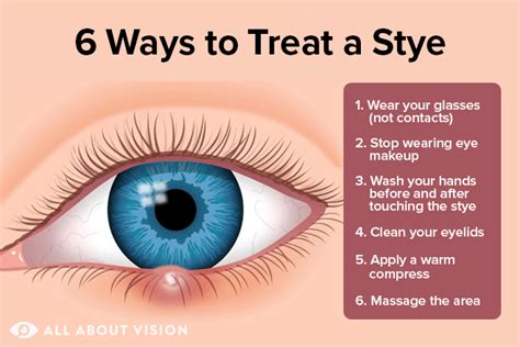 Stye Inside Eyelid