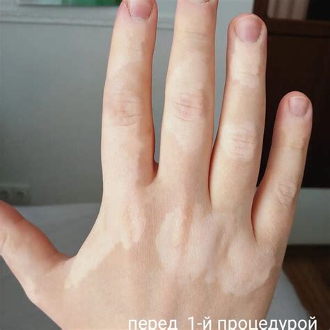 Фото витилиго до и после | Кабинет татуажа Алены Леоновой