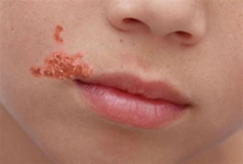 Types of Bacterial Skin Infections and How to Treat Them