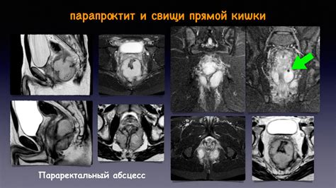 Визуализация прямой кишки и перианальной области