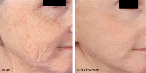 microneedling  prp    face fitness skin care