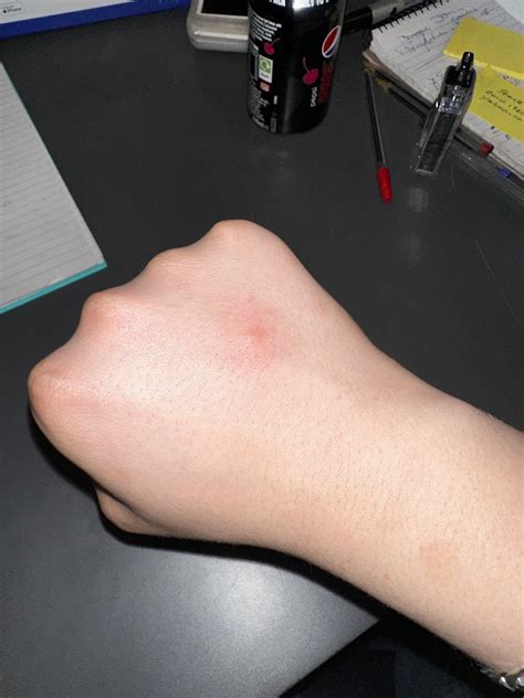 Red itchy spots On day 5 : r/prozac