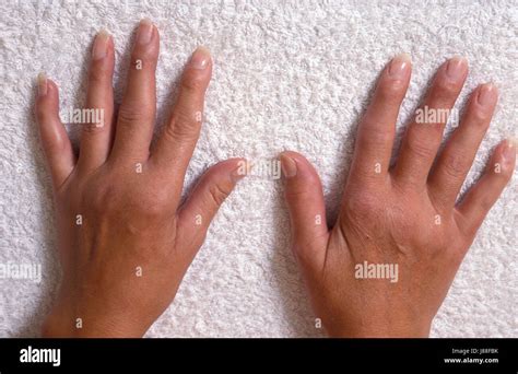 Adult arthritis hi-res stock photography and images - Alamy
