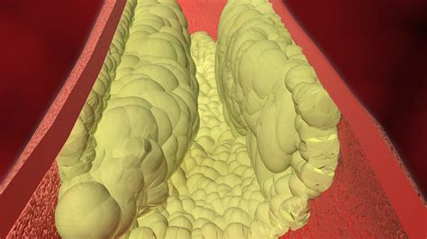 high cholesterol facts cholesterol cdc