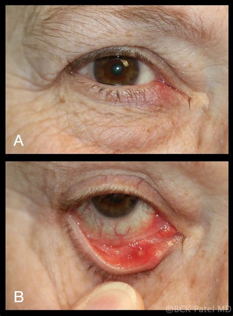 Moran CORE | What are the differences between a stye, a chalazion, an ...