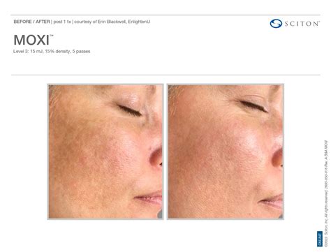 Moxi® in Florence, KY | Elle Skin & Beauty Co.