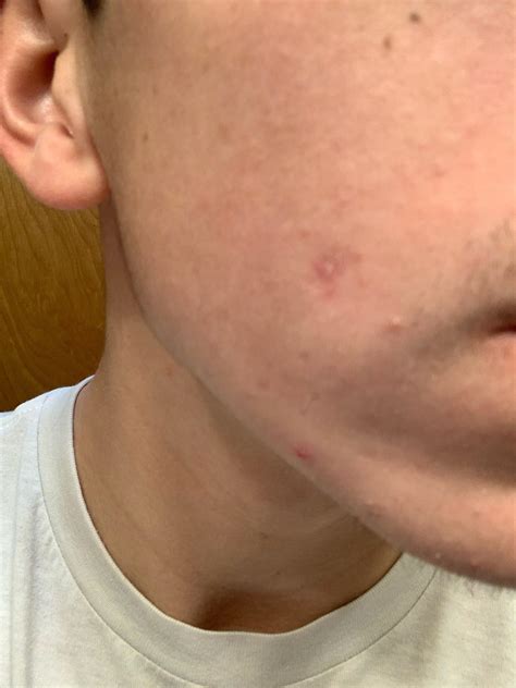 Biggest cysts popped videos cause a stir in dermatology 20