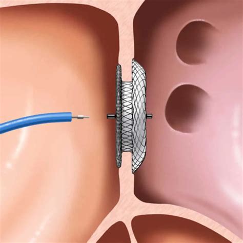 ASD/VSD/PDA/ Device Closure Surgery Cost in Ludhiana, Punjab, India