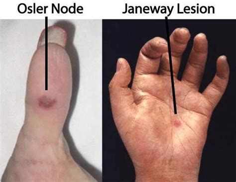 Janeway Lesions | Salute, Medicina