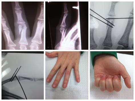 Thumb Fracture Treatment