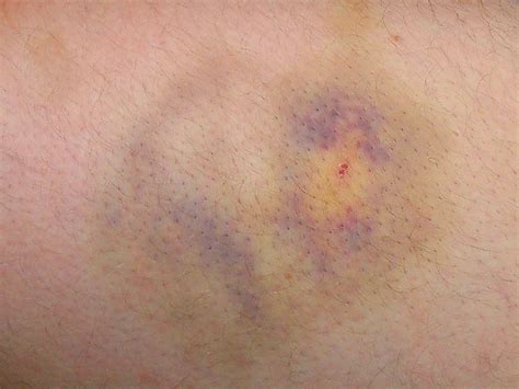 bruised skin      hide