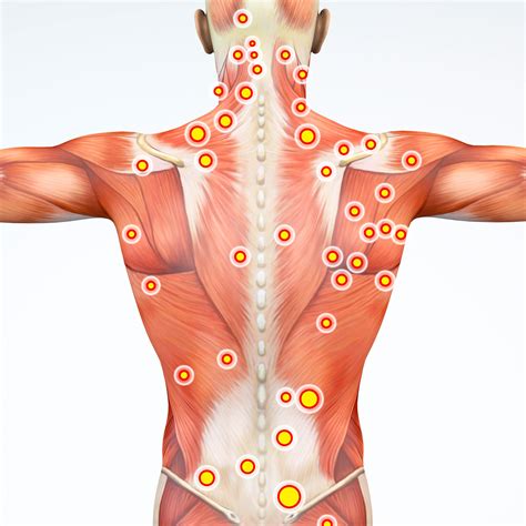 Dry Needling Services - Epic Physical Therapy, CO