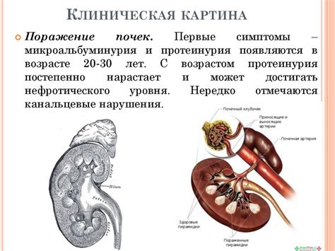 Болезнь Фабри - презентация онлайн