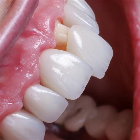 Corona Dental Metalica