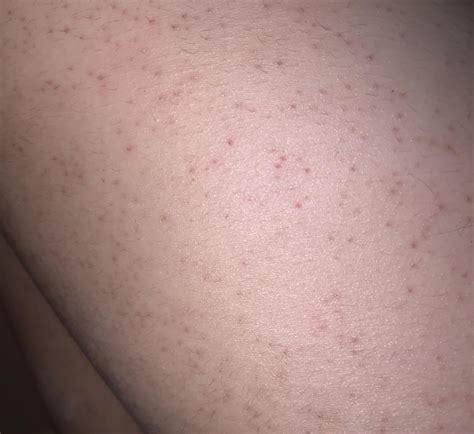 Are the red dots on my back(pictured) KP? I have kp on my upper arms