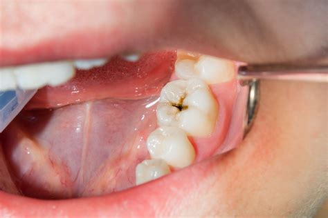 mild tooth cavity