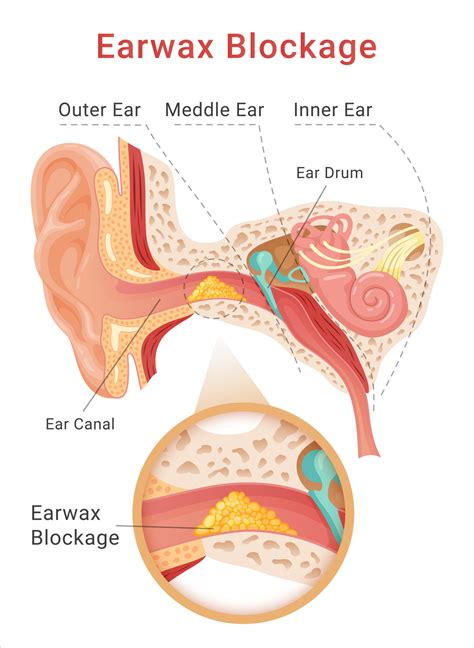 Blocked Ears: Reasons Behind Blocked Ears - Crystal Clear Clinic