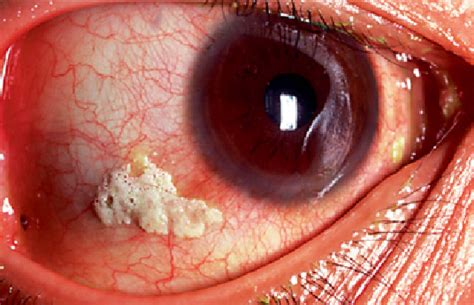 1. Bitot's spots. The foamy raised lesion on the temporal conjunctiva ...