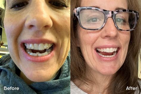 Before and After Motto Clear Aligners: Reviews | Aspen Dental