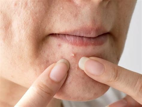 jerawat  bawah bibir kenali penyebab   mengatasinya