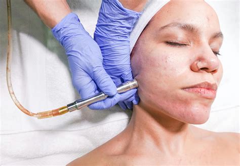 Clear Skin Ahead: Best Acne Scarring Treatments - JOHN-AMBLER.COM
