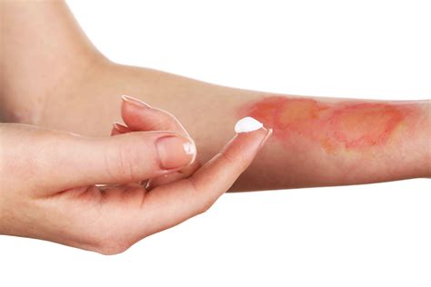 The Best Home Remedies For Soothing Painful Roller Burns And Preventing Long Term Skin Scarring Today