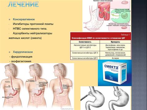 Пищевод Барретта - презентация онлайн