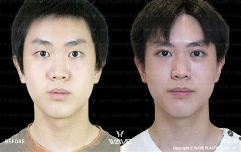hasta ahora Oficiales 945 wave plastic surgery fluir Envío Chaleco