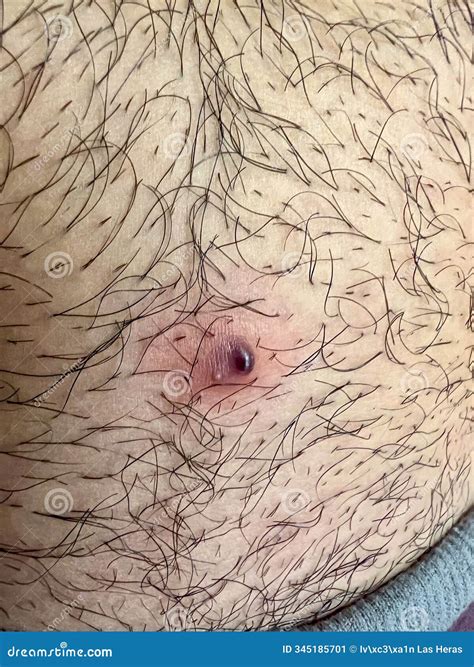Close-up of Inflamed Skin Bump with Hair Stock Image - Image of